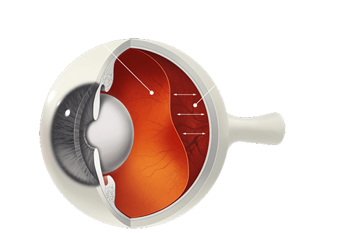 Retinal Detachment