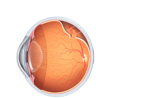 Retinal Detachment